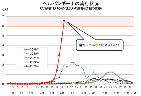 大阪・東京でヘルパンギーナが警報レベル超え、コロナも流行拡大